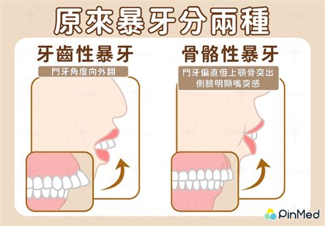 門牙暴牙面相|【暴牙面相】暴牙面相大解析：見證個性特質與運勢變化！